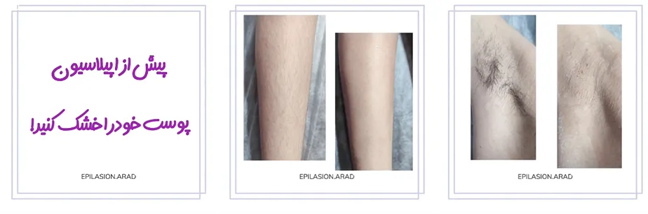 کلینیک آراد یکی از بهترین مرکز اپیلاسیون در مشهد است