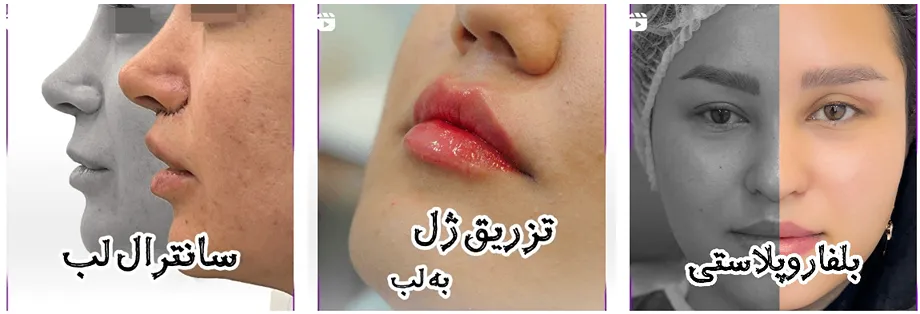 بوتاکس در مشهد در کلینیک آرارز کاملا قابل انجام است