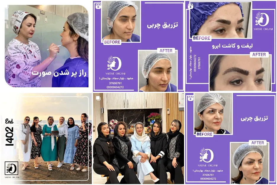 دکتر ارگنجی از بهترین دکتر تزریق چربی در مشهد است