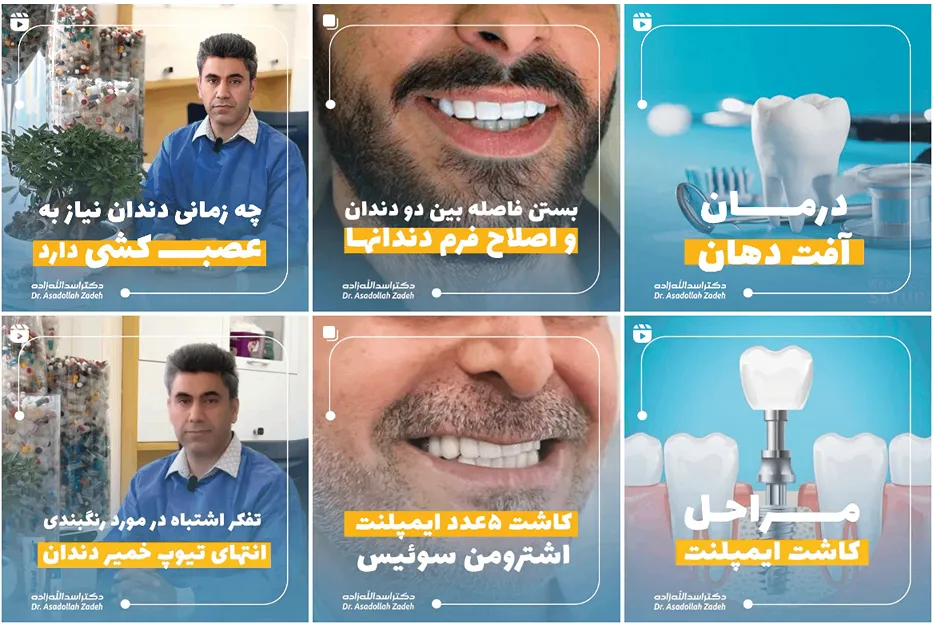 ایمپلنت دندان در مشهد توسط دکتر اسدا... زاده قابل انجام است