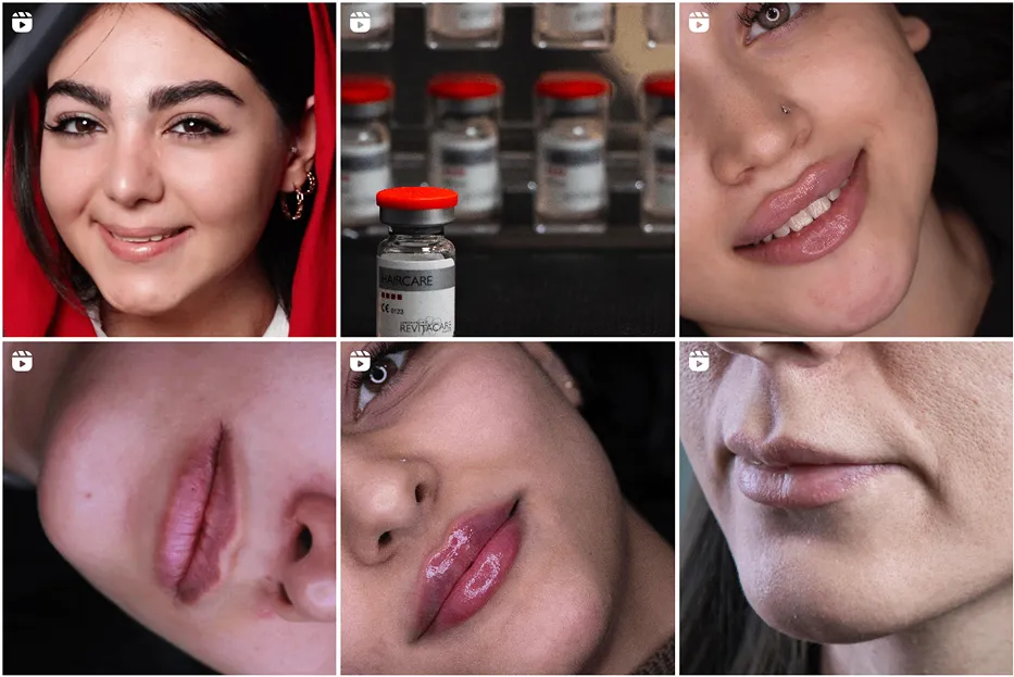 تزریق ژل لب روسی در مشهد توسط دکتر خانزاده کاملا قابل انجام است