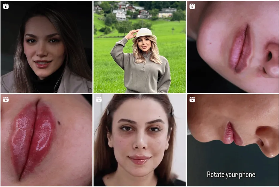 کانتورینگ صورت در مشهد توسط دکتر خانزاده کاملا قابل انجام است