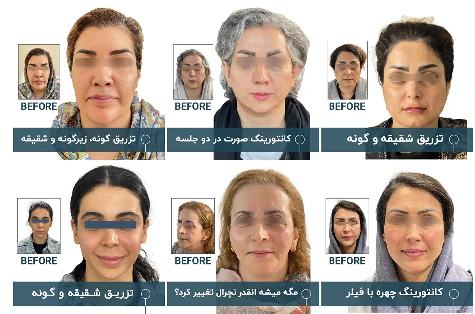کانتورینگ صورت در مشهد توسط دکتر باقریه قابل انجام است