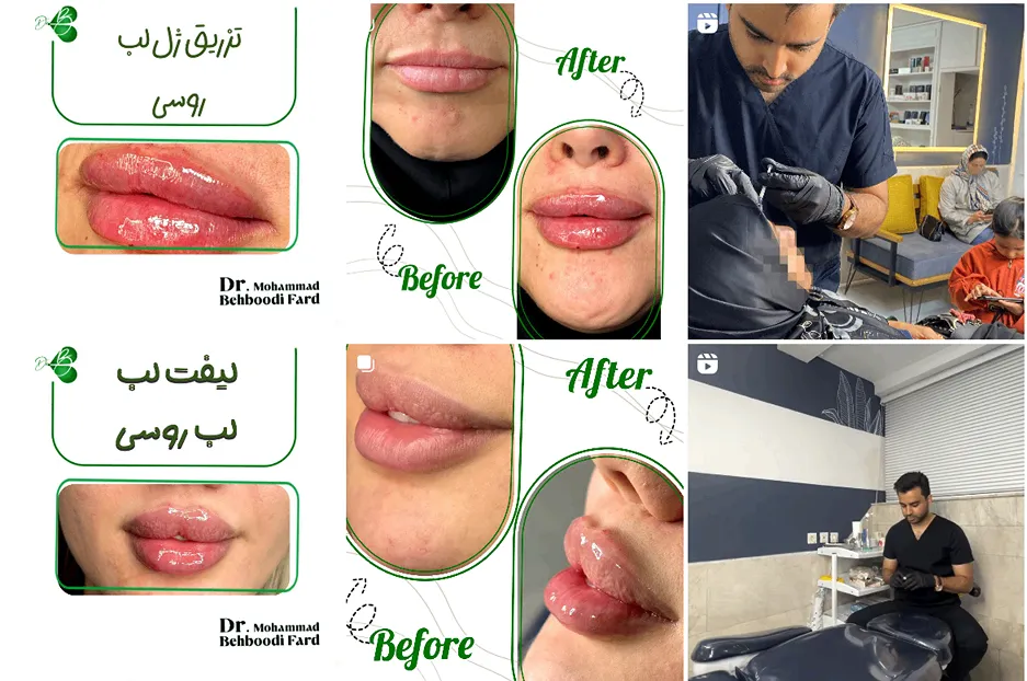 تصویر یکی از بهترین مرکز ژل لب روسی در مشهد را مشاهده میفرمایید.