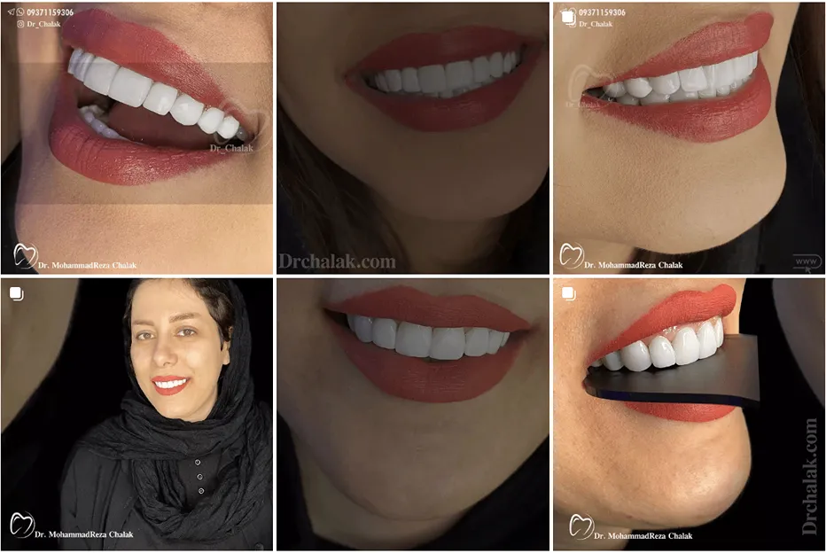 ایمپلنت در مشهد توسط دکتر چالاک کاملا قابل انجام است