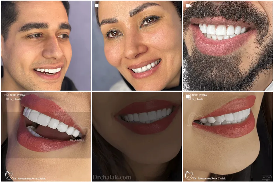 لمینت دندان در مشهد توسط دکتر چالاک کاملا قابل انجام است