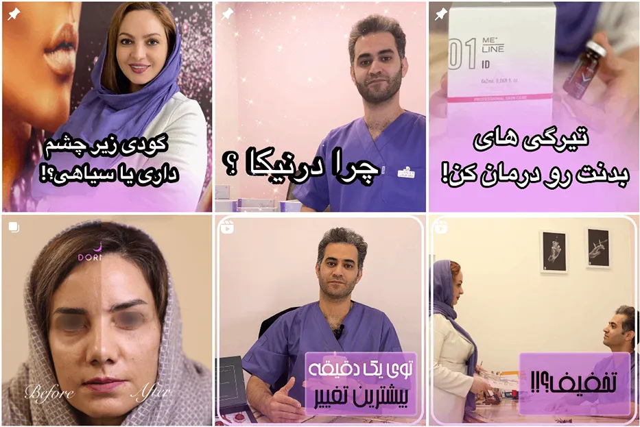 نمونه کار بهترین دکتر تزریق بوتاکس در مشهد را مشاهده میفرمایید