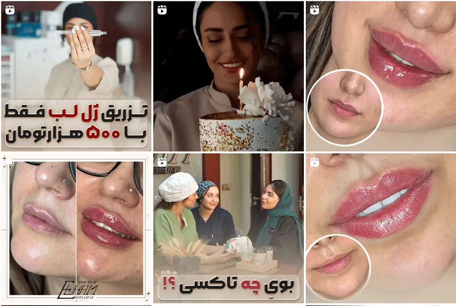 نمونه کار یکی از بهترین دکتر تزریق بوتاکس در مشهد را مشاهده میفرمایید.