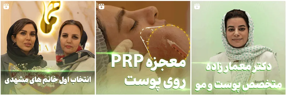 بلفاروپلاستی در مشهد در کلینیک زیبایی همای گلشن کاملا قابل انجام است