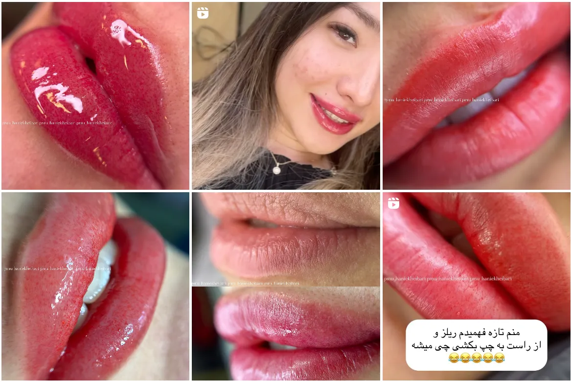 تصویر یکی از بهرتین نمونه کار شیدینگ لب در مشهد را مشاهده میفرمایید.