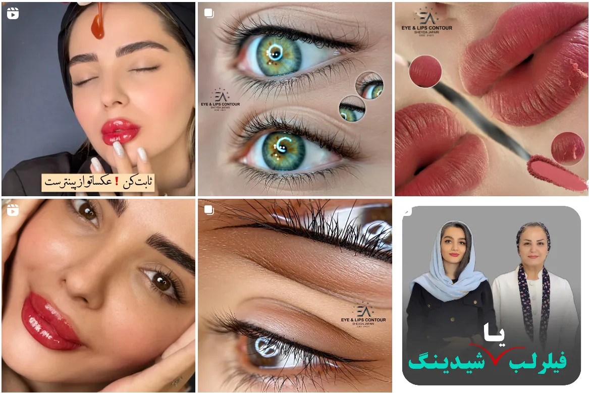 تصویر یکی از بهترین مرکز شیدینگ لب در مشهد را مشاهده میفرمایید.