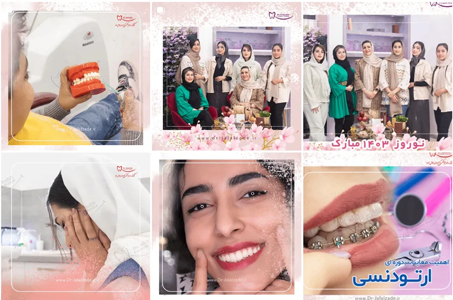 لمینت دندان در مشهد توسط دکتر جلال زاده قابل انجام است