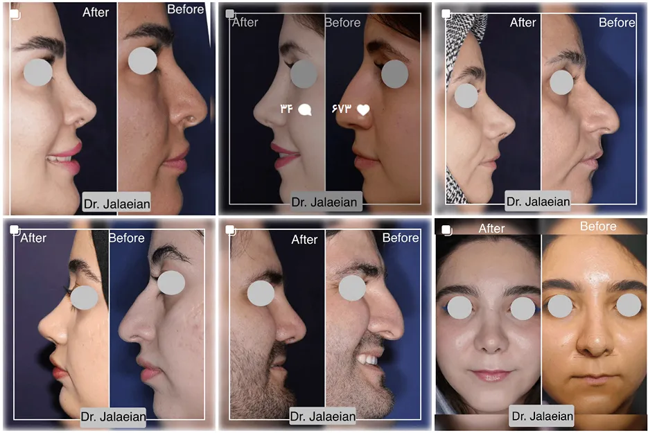 تصویر یکی از بهترین جراح بینی در مشهد را مشاهده میفرمایید.