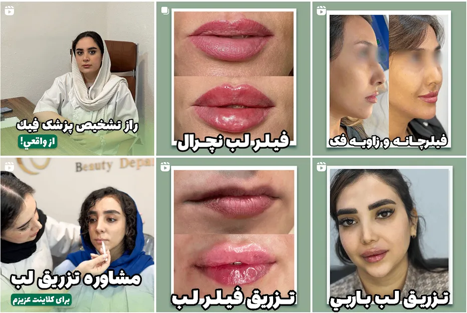 نمونه کار یکی از بهترین دکتر تزریق بوتاکس در مهد را مشاهده میفرمایید