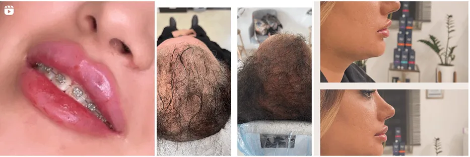 دکتر کاشانیفر یکی از بهترین دکتر هایفوتراپی در مشهد است