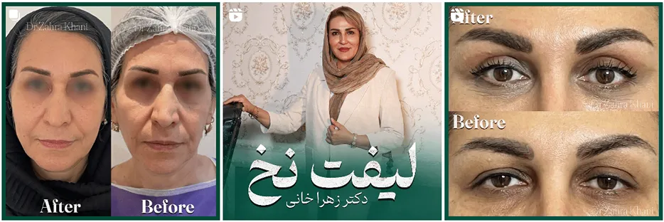 دکتر زهرا خانی یکی از جاح لیفت صورت در مشهد است
