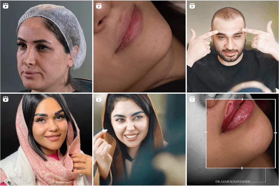 نمونه کار بهترین کلینیک بوتاکس در مشهد را مشاهده بفرمایید