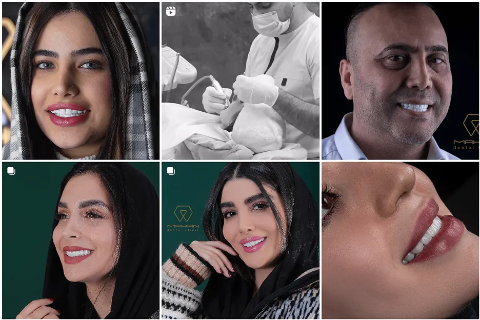 لمینت در مشهد توسط کلینیک ماهان قابل انجام است