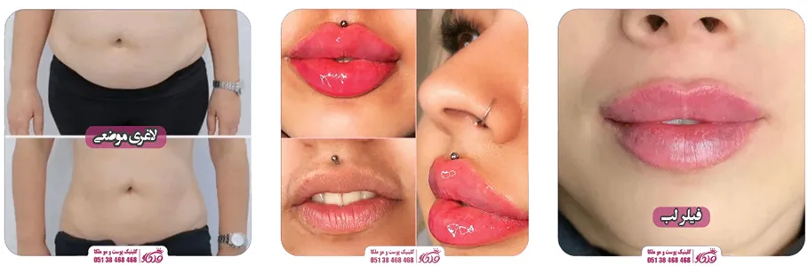 کلینیک زیبایی ملکا یکی از بهترین مرکز پی ار پی در مشهد است