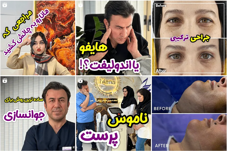 تزریق فیل در مشهد توسط کلینیک زیبایی مانا قابل انجام است