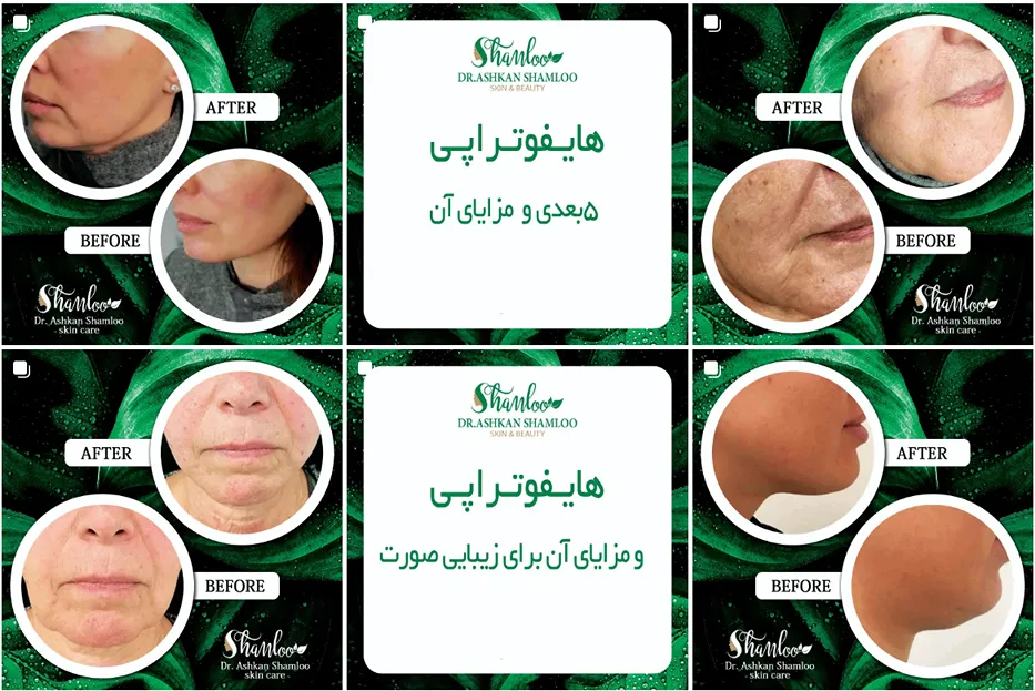 کربوکسی تراپی مشهد توسط دکتر شاملو قابل اجرا است