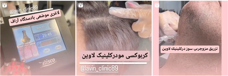 کلینیک لاوین یکی از بهترین کلینیک هایفوتراپی در مشهد است