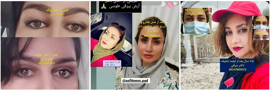 دکتر بیرقی از بهترین جراح بلفاروپلاستی در مشهد است