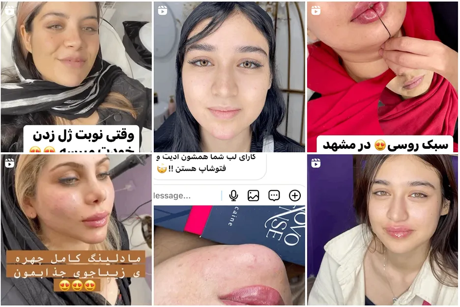 ژل لب روسی در مشهد توسط کلینیک پوست و مو مشهد کاملا قابل انجام است