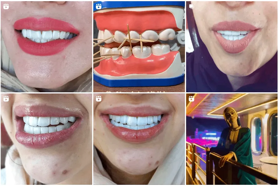 لمینت دندان در مشهد توسط دکتر مفظری کاملا قابل اجرا است