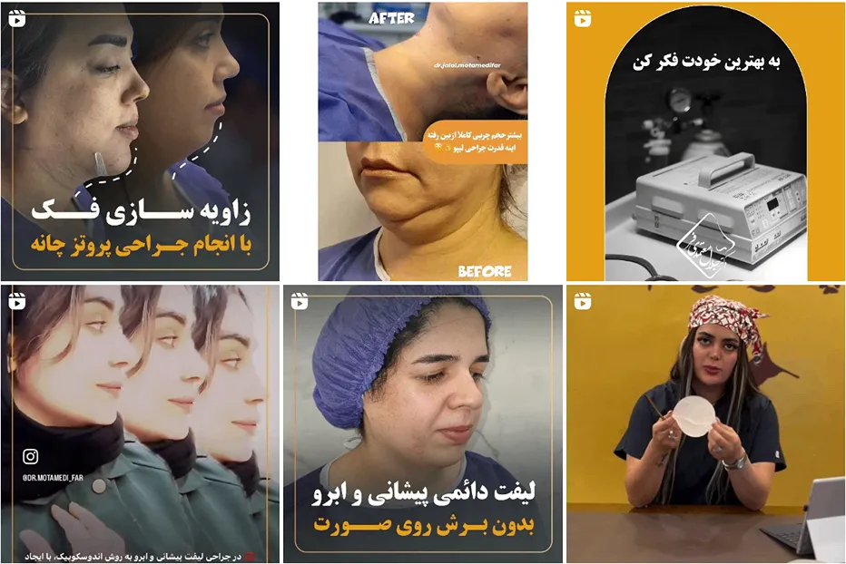 عمل پروتز سینه در مشهد توسط دکتر معتمدی فر کاملا قابل انجام است