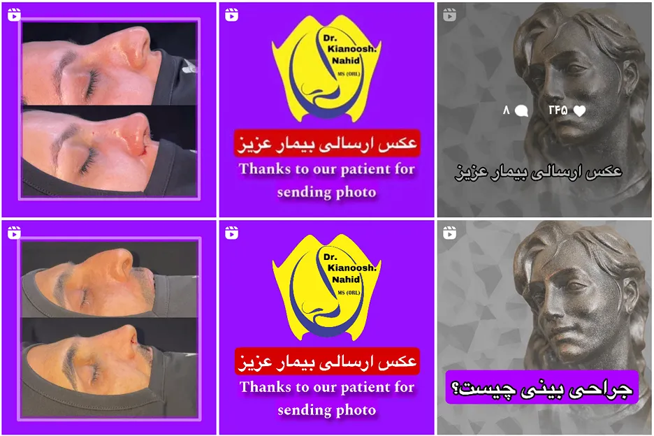 عمل بینی در مشهد توسط دکتر ناهید کاملا قابل اجرا است