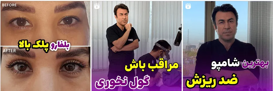 اندولیفت در مشهد توسط دکتر نوری کاملا قابل انجام است