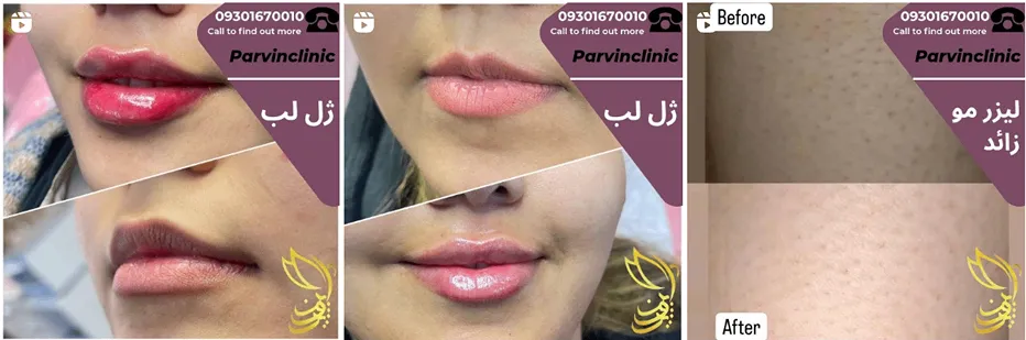 میکرونیدلینگ در مشهد توسط کلینیک پروین کاملا قابل انجام است