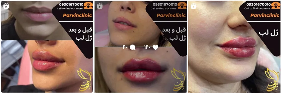 کلینیک زیبایی پروین یکی از بهترین کلینیک پی ار پی در مشهد است