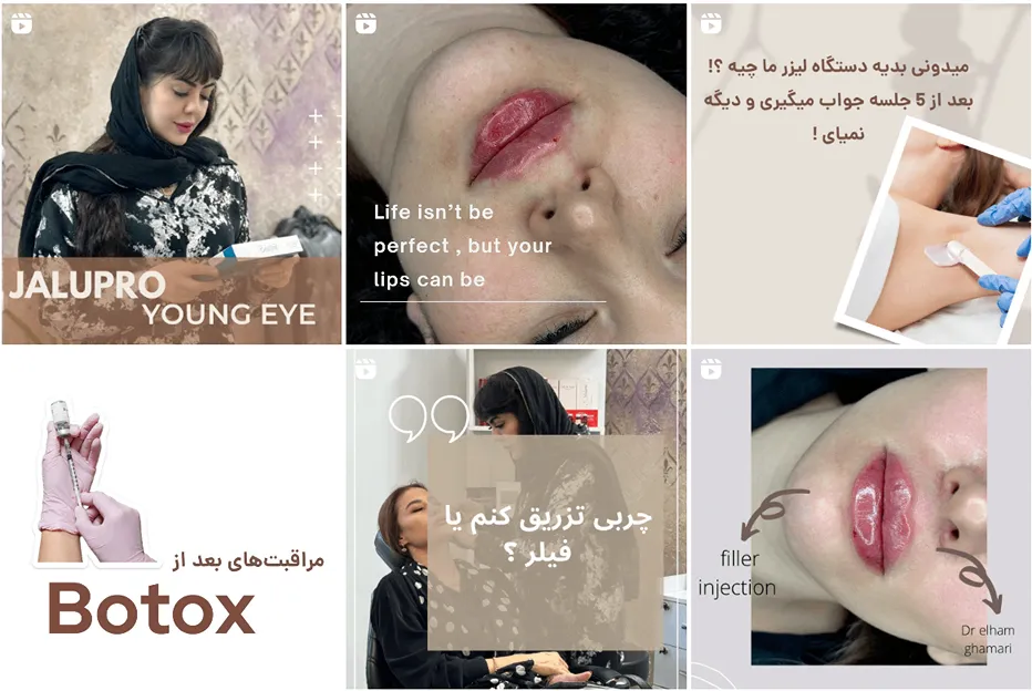 کانتورینگ صورت در مشهد توسط دکتر قمری کاملا قابل اجرا است