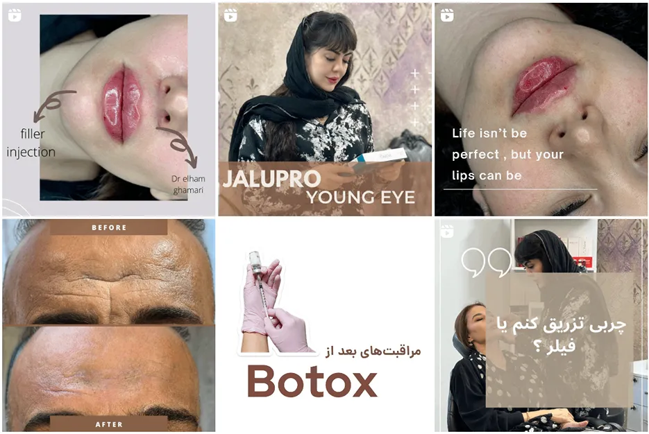 نمونه کار بهترین دکتر تزریق بوتاکس در مشهد