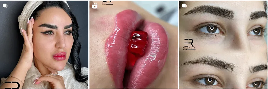 میکروبلیدینگ در مشهد توسط خانم رضایی کاملا قابل انجام است