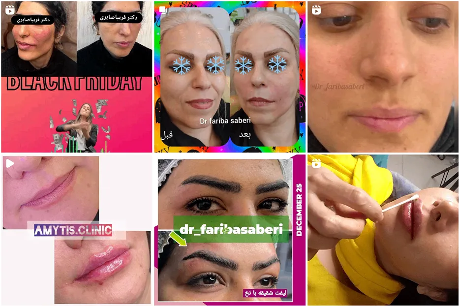 کلینیک زیبایی فریبا صابری از بهترین کلینیک تزریق چربی در مشهد است