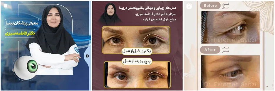 دکتر سبزی یکی از بهترین جراح بلفاروپلاستی در مشهد است