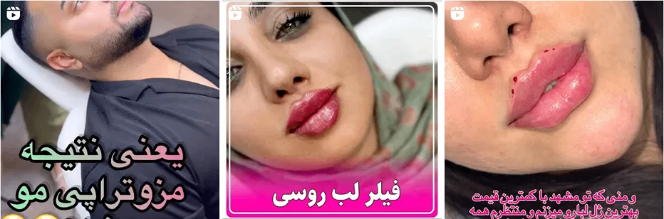 کلینیک سایه یکی از بهترین مرکز هایفوتراپی در مشهد است