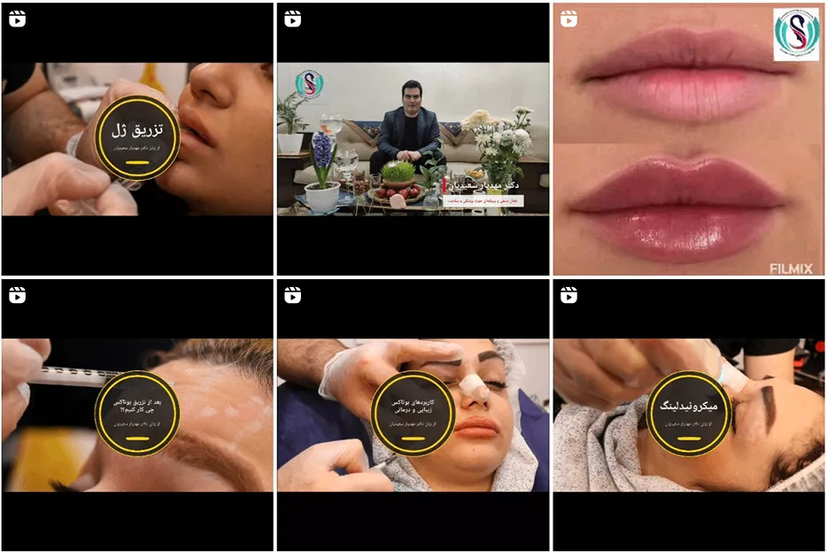 میکرونیدلینگ در مشهد توسط دکتر سعیدیان کاملا قابل انجام است