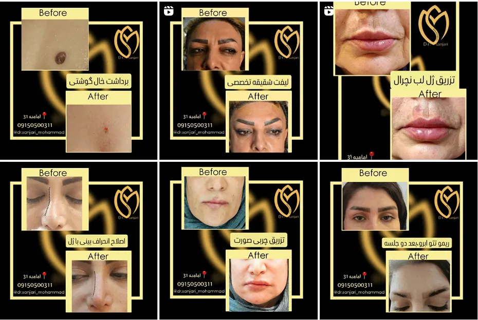 تزریق چربی در مشهد در کلینیک زیبایی سنجر کاملا قابل انجام است