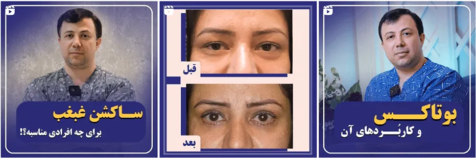 لیفت صورت در مشهد توسط دکتر سنجری کاملا قابل انجام است