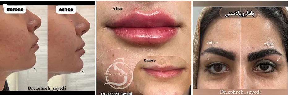 میکرونیدلینگ در مشهد توسط دکتر توانا قابل انجام است