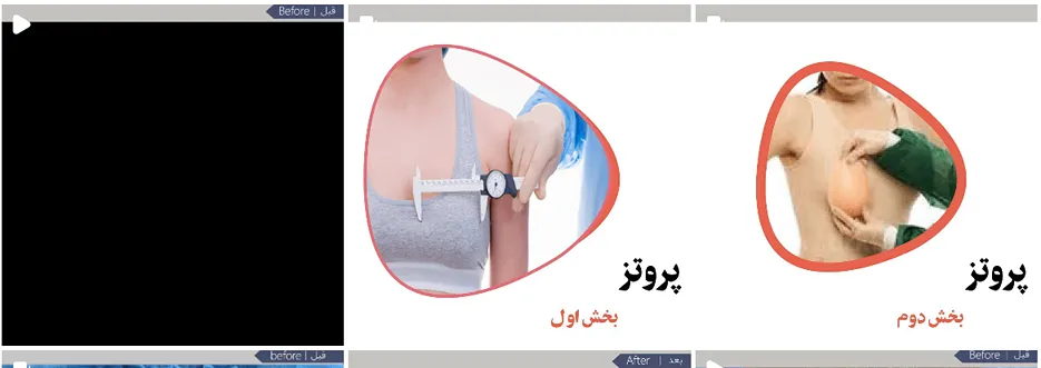 پروتز سینه در مشهد توسط دکتر شریفی کاملا قابل انجام است