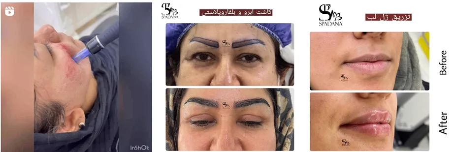 اندولیفت در مشهد در مرکز زیبایی اسپادانا کاملا قابل انجام است