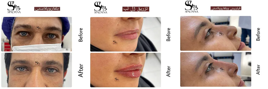 هزینه لیفت صورت در مشهد به عوامل مختلفی وابسته است