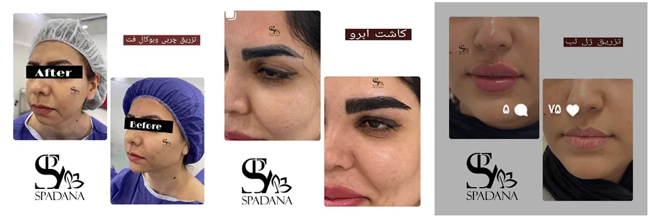 کلینیک اسپادانا کی از بهترین کلینیک هایفوتراپی در مشهد است