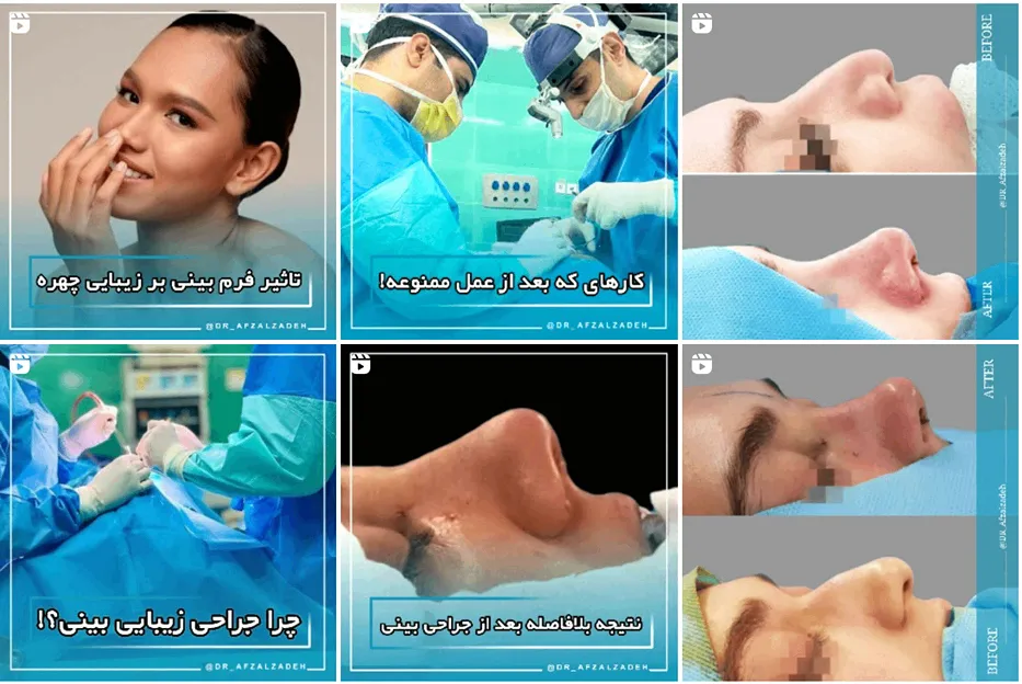 عمل بینی در مشهد توسط دکتر افضل زاده کاملا قابل اجرا است