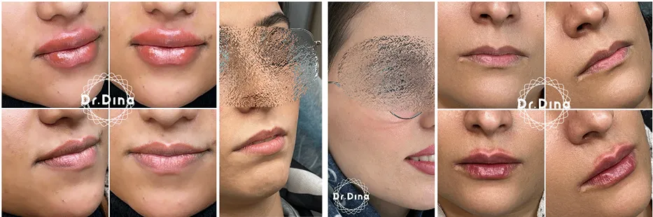 کیکرونیدلینگ در مشهد توسط دکتر توانا قابل انجام است